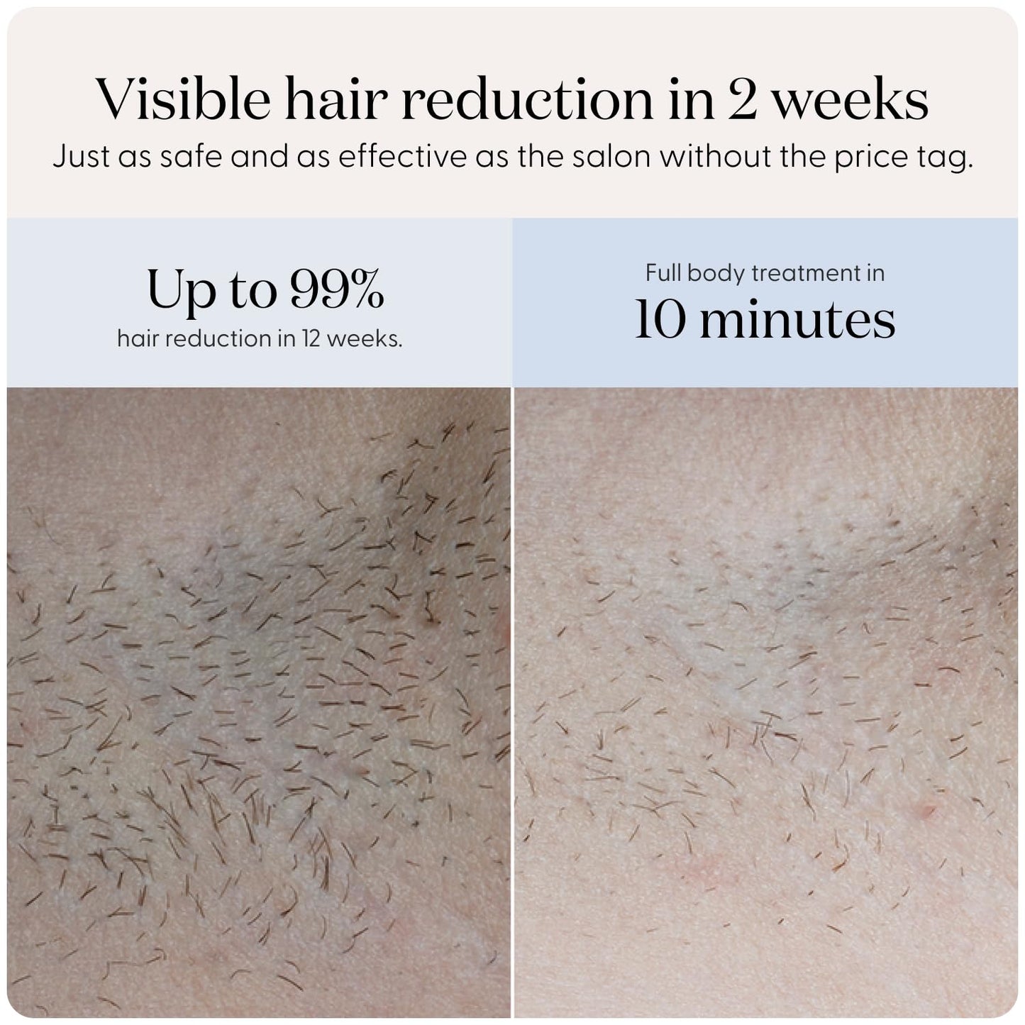 Smoothskin Pure Fit IPL Laser Hair Removal Device, for Body & Face, Long-Lasting Hair Removal from Home, Alternative to Laser, with Precision Head